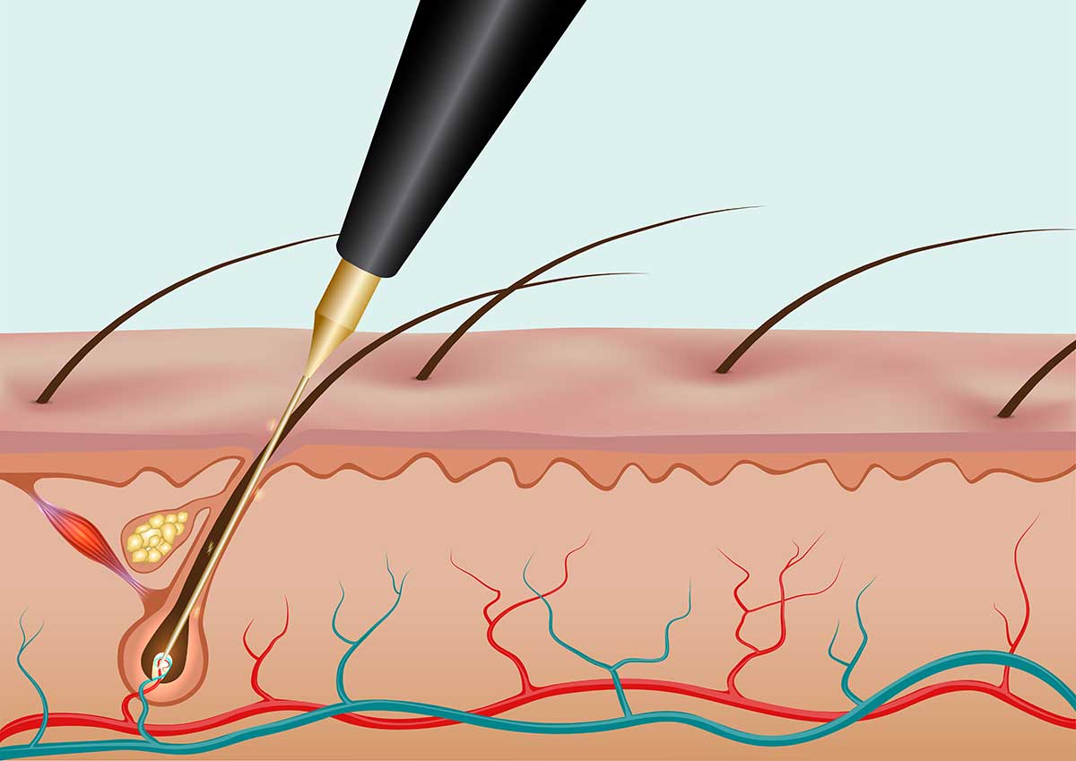 electrolysis chin hair removal in valley