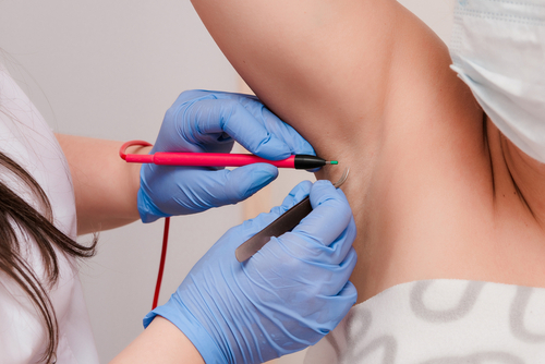 electrolysis unwanted hair removal